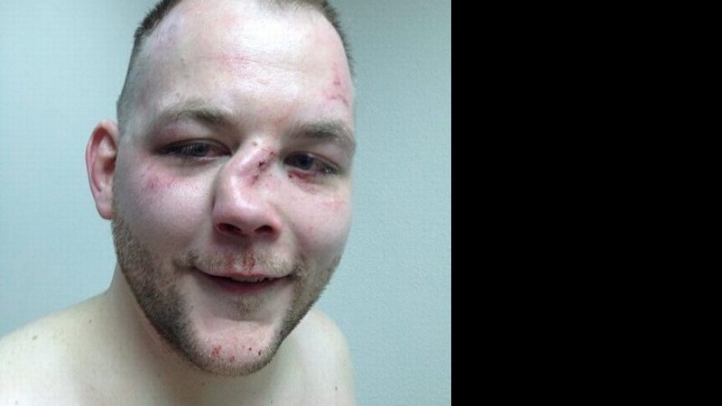Imagem Lutador exibe nariz desfigurado após combate de MMA