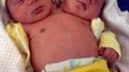 Imagem Gêmeos nascem com duas cabeças e único corpo